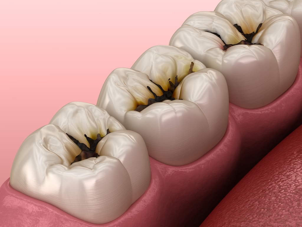 Treatment of Caries