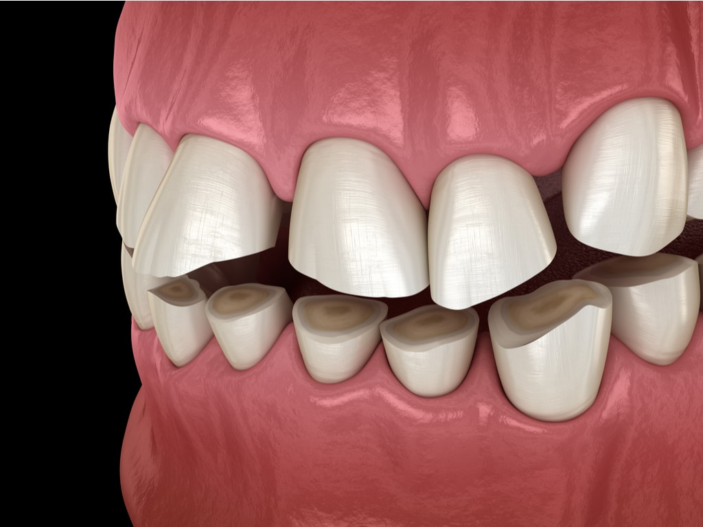 Bruxisme | Clinique Dentaire de Neuchâtel | Dentiste Neuchâtel ...