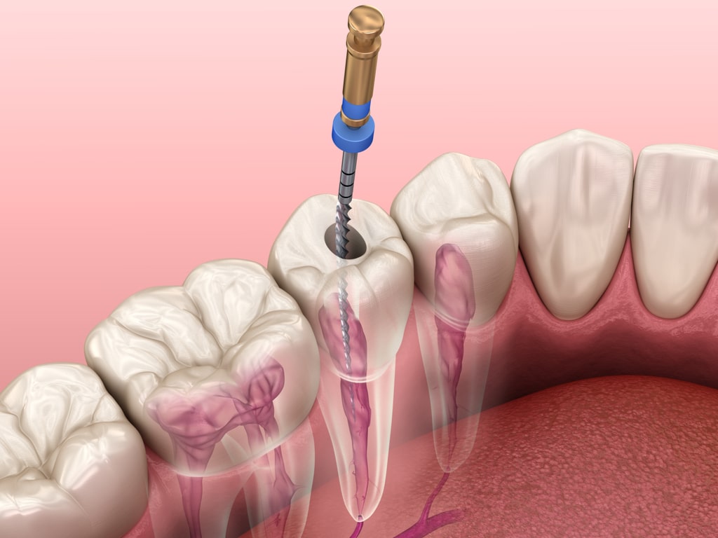 Root Canal Treatment