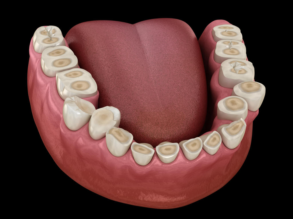 Bruxisme, Clinique Dentaire de Neuchâtel, Dentiste Neuchâtel, Grincement, Serrage