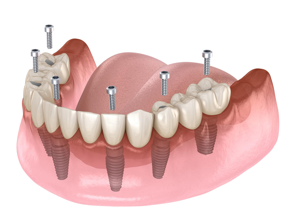 iamge Dents fixes en 1 journée