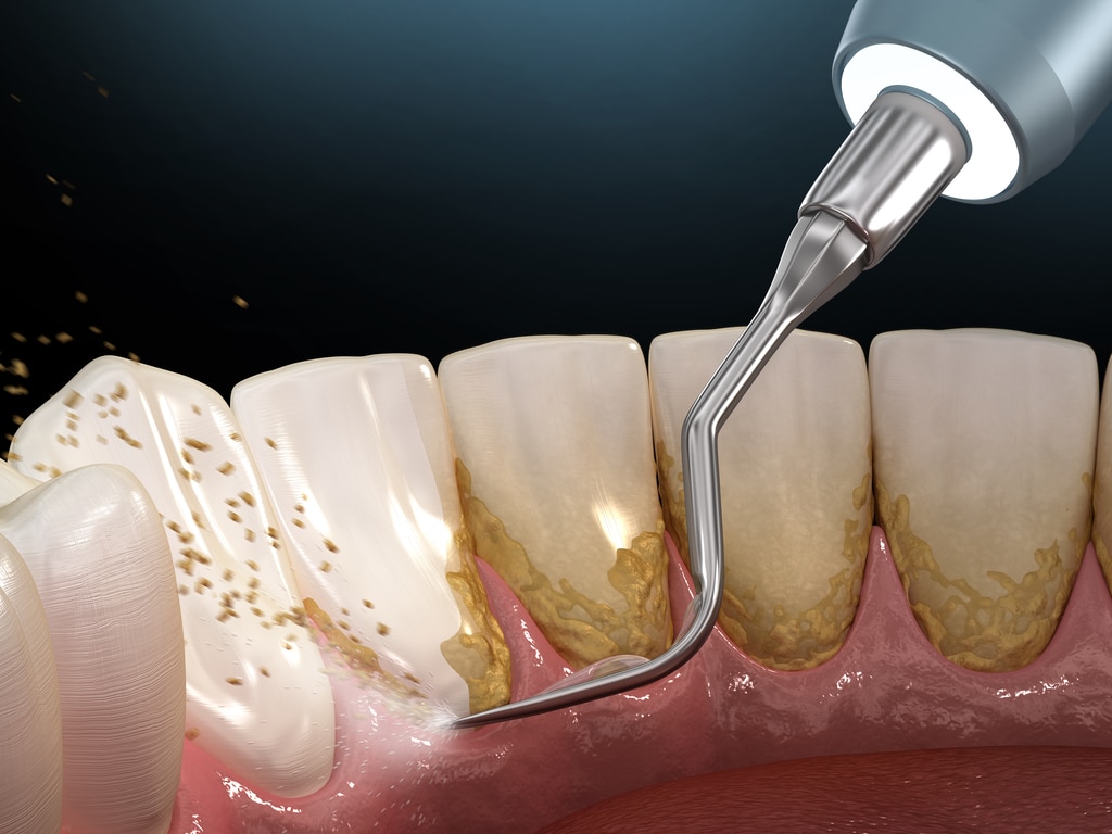 Descaling and Whitening