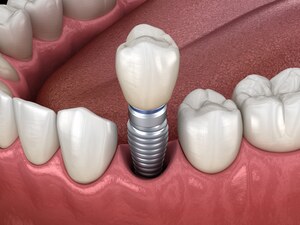 зубные имплантаты