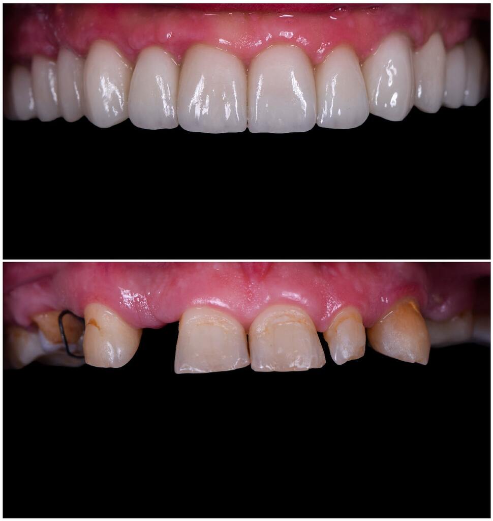 reconstruction complète du sourire et de la fonction masticatoire 